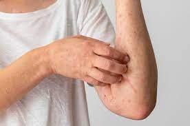 IPS orienta sobre dermatoses ocupacionais