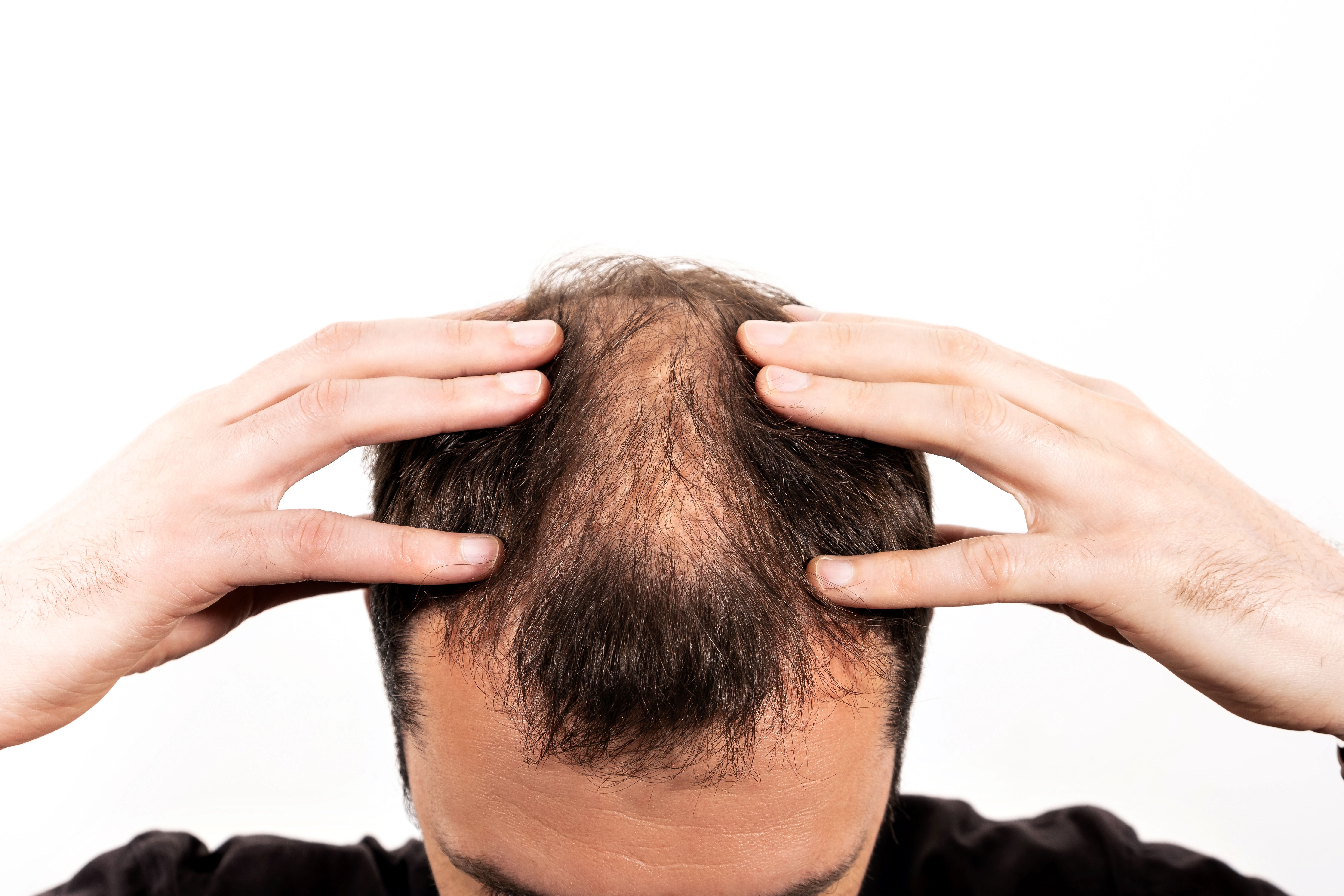 Alopecia: técnicas de tricologia podem oferecer soluções