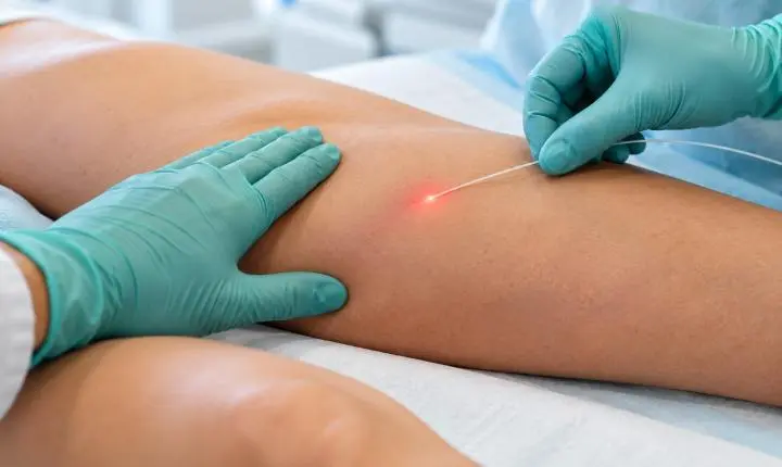 Laser permite tratar a safena sem retirar a veia da perna